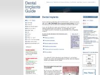 Dental Implants Guide Dental Implants Guide