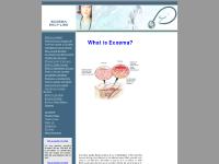 Ecxema pictures, treatment, Ecxema information Ecxema pictures, treatment, Ecxema information