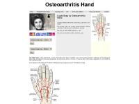 Osteoarthritis Hand - Osteoarthritis of the Hand Osteoarthritis Hand - Osteoarthritis of the Hand